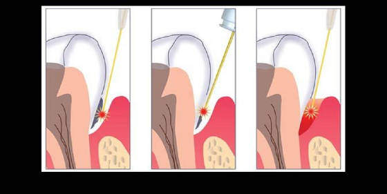 Laser Periodontics Treatment