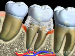 Moderate Periodontal Disease showing Tartar Buildup In Periodontal Pocket