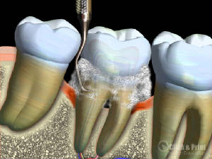 Scraping Away Plaque And Tartar Buildup