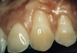 Periodontal Esthetics Treatment