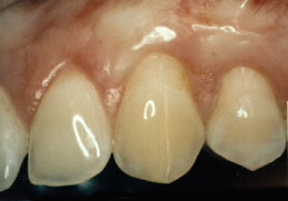 Periodontal Esthetics Treatment