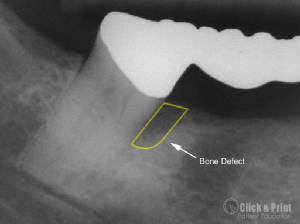 Bone Loss On The Right Side Of The Tooth