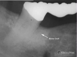 Bone Fill Following Guided Tissue Regeneration