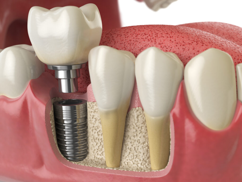 Dental Implant Treatment